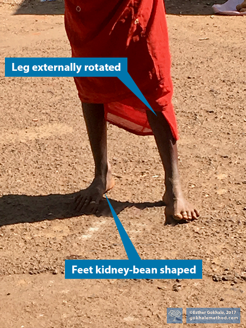 Photo of  kidney bean shaped feet and externally rotated legs.