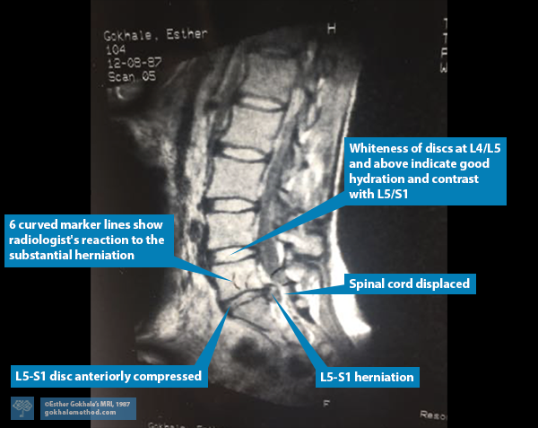 Image of Esther Gokhale’s MRI showing a large herniation at L5-S1.
