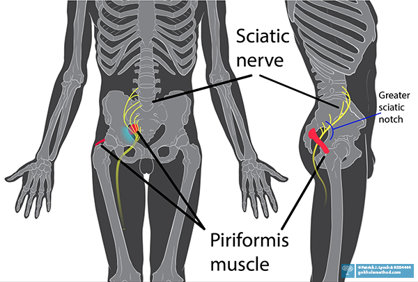 Front and side-view diagrams of sciatic nerves in skeleton/body.