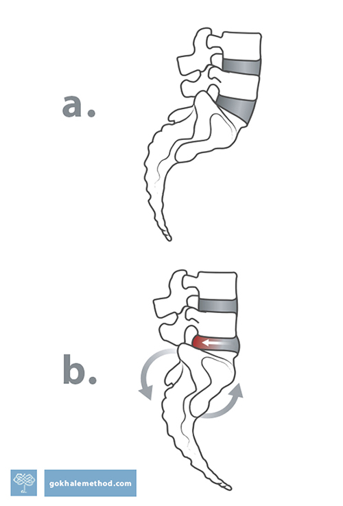 Two diagrams of vertebrae showing anteverted and tucked sacrum and L4&5 