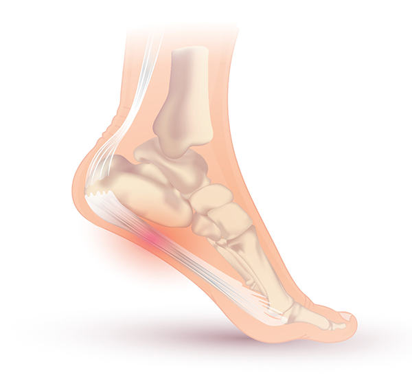 Drawing of a foot with inflamed plantar fascia.