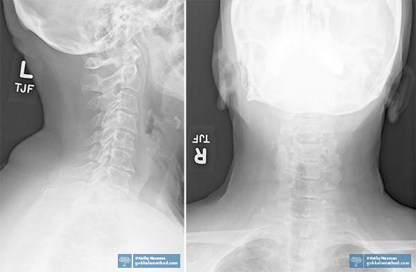  2 of Gokhale Method Alumna Kathy Nauman’s neck X-rays.