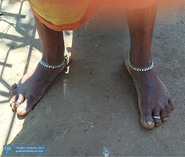 Photo of woman’s kidney-bean shaped feet, from Odisha, India.